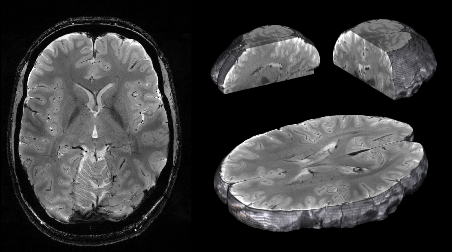 MRI Scan
